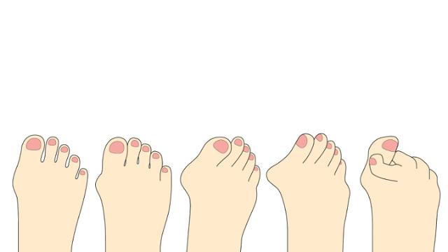 Pretty feet with bunions