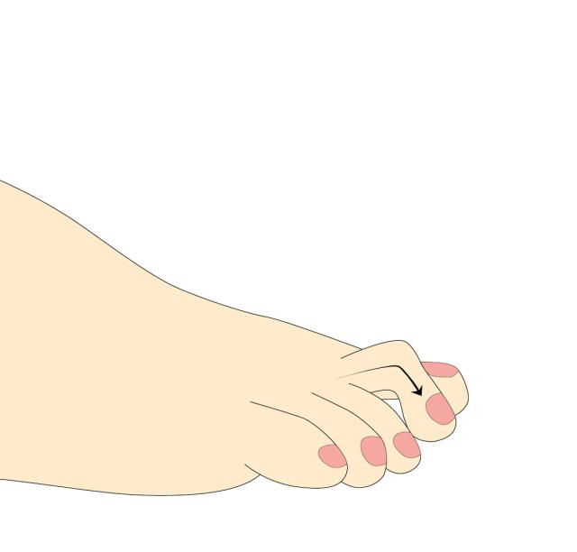 What causes hammer toes?